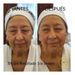 Radiofrecuencia TriLipo Tensado Facial + Activación Muscular + Masaje Facial