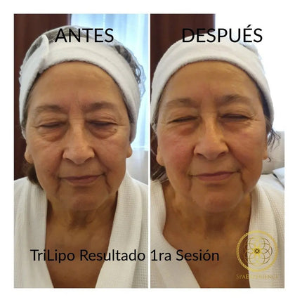 Radiofrecuencia TriLipo Tensado Facial + Activación Muscular + Masaje Facial